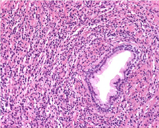 IgG4, malattia ‘camaleonte’ che inganna tutti. Nel Lazio colpite circa 290 persone, anche 2 anni per la diagnosi